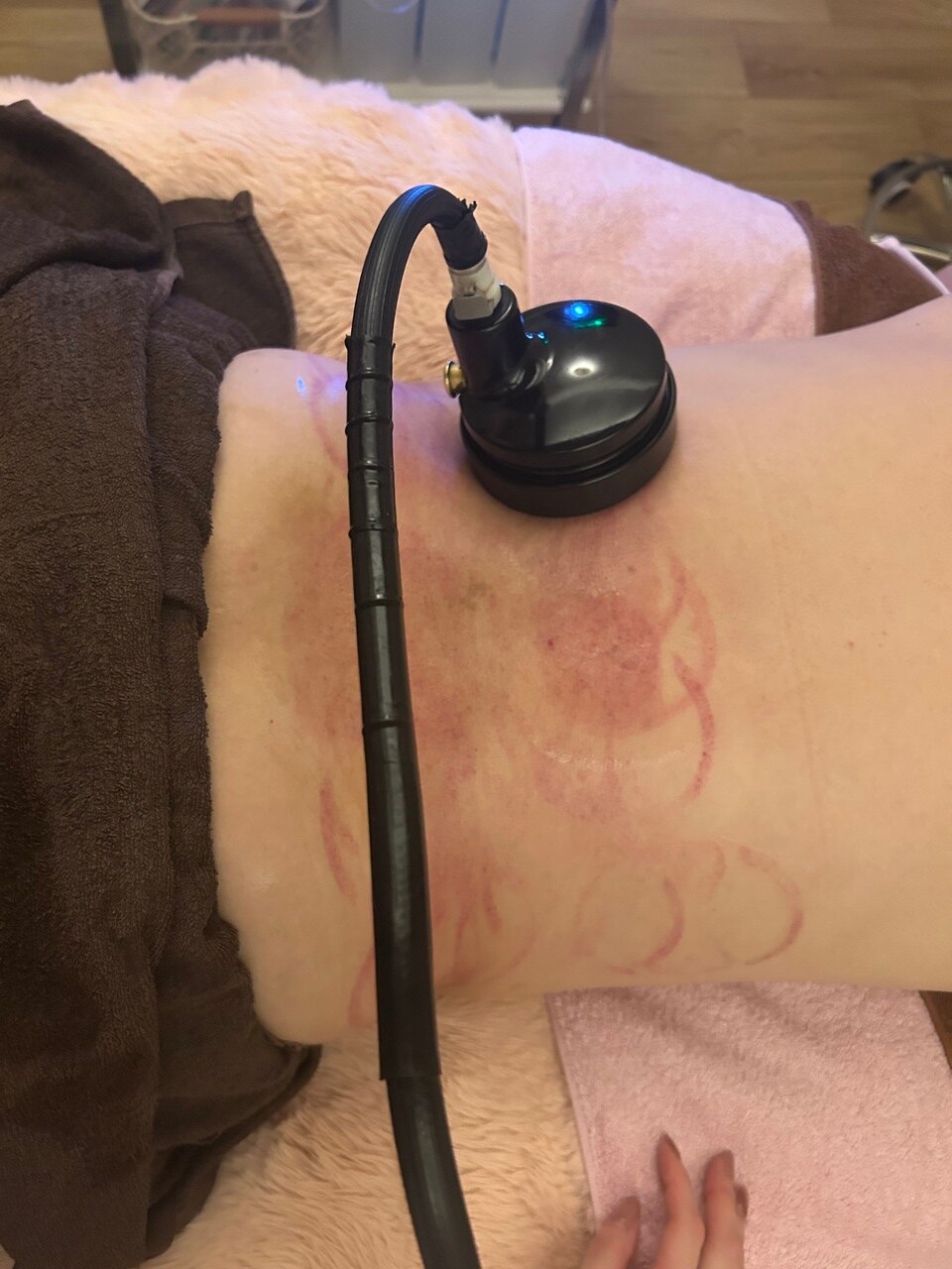 カッピングで毒素だし